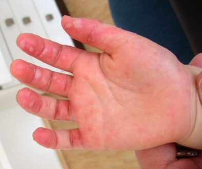 Close view of a child’s hand with a hand, foot and mouth disease rash.