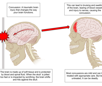 Educational diagram illustrating the mechanics of a concussion inside the skull.
