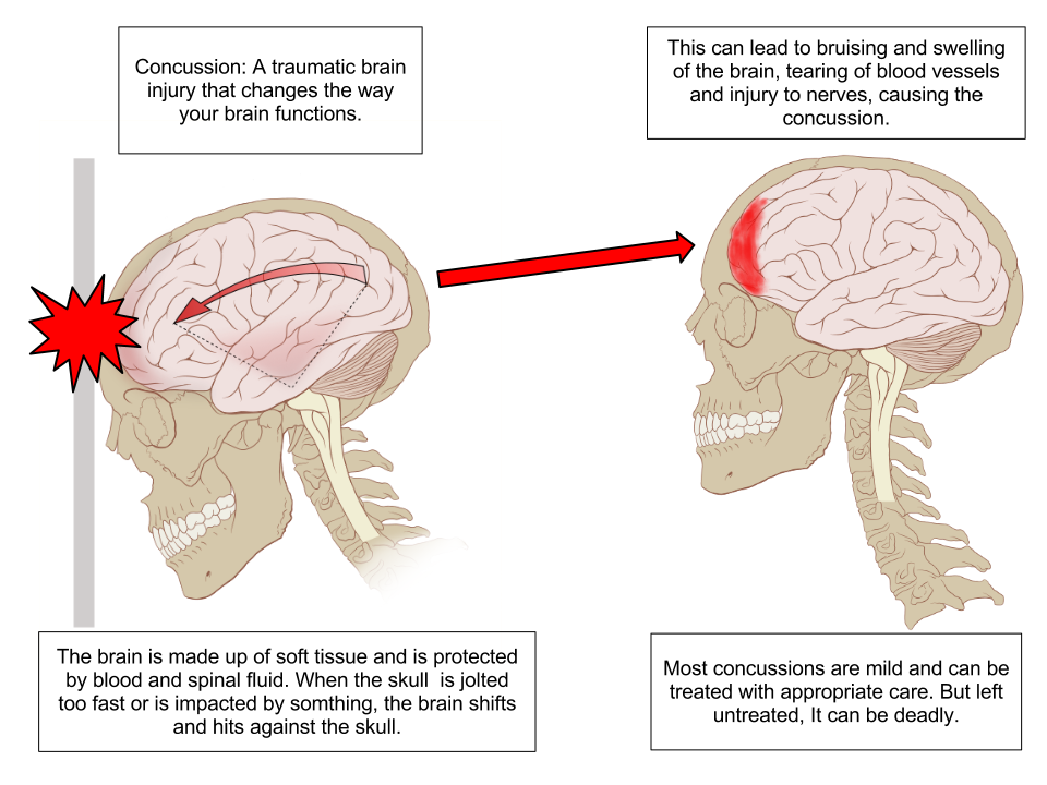 Educational diagram illustrating the mechanics of a concussion inside the skull.
