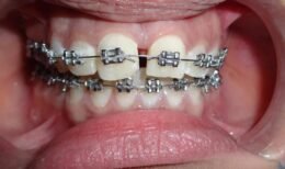 Orthodontic braces, illustrating a first orthodontic evaluation for a school-age child.