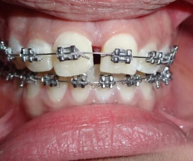 Orthodontic braces, illustrating a first orthodontic evaluation for a school-age child.